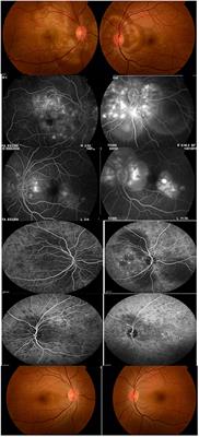 New Perspectives on the Immunopathogenesis and Treatment of Uveitis Associated With Vogt-Koyanagi-Harada Disease